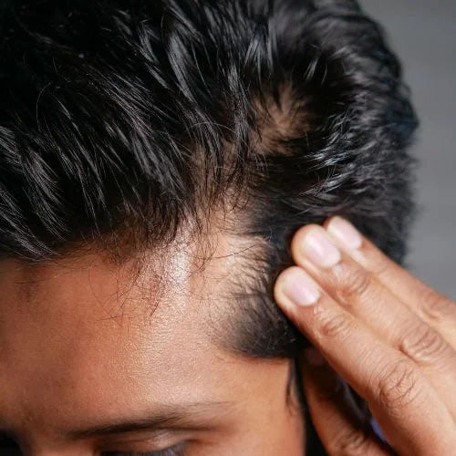 Photograph of Man loosing his hair.