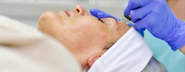 Woman receiving Micro-Needling Treatment