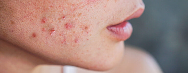 closeup acne on woman's face with rash skin ,scar and spots